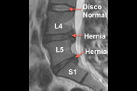 Lower back pain for kayakers hernia